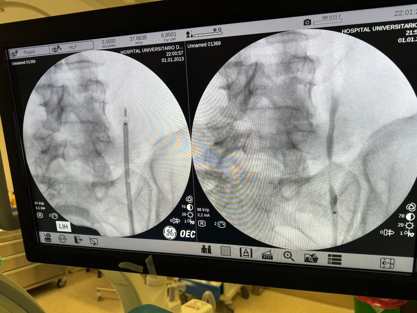 El HUCE implanta con éxito el primer stent de tecnología avanzada Allium en Ceuta