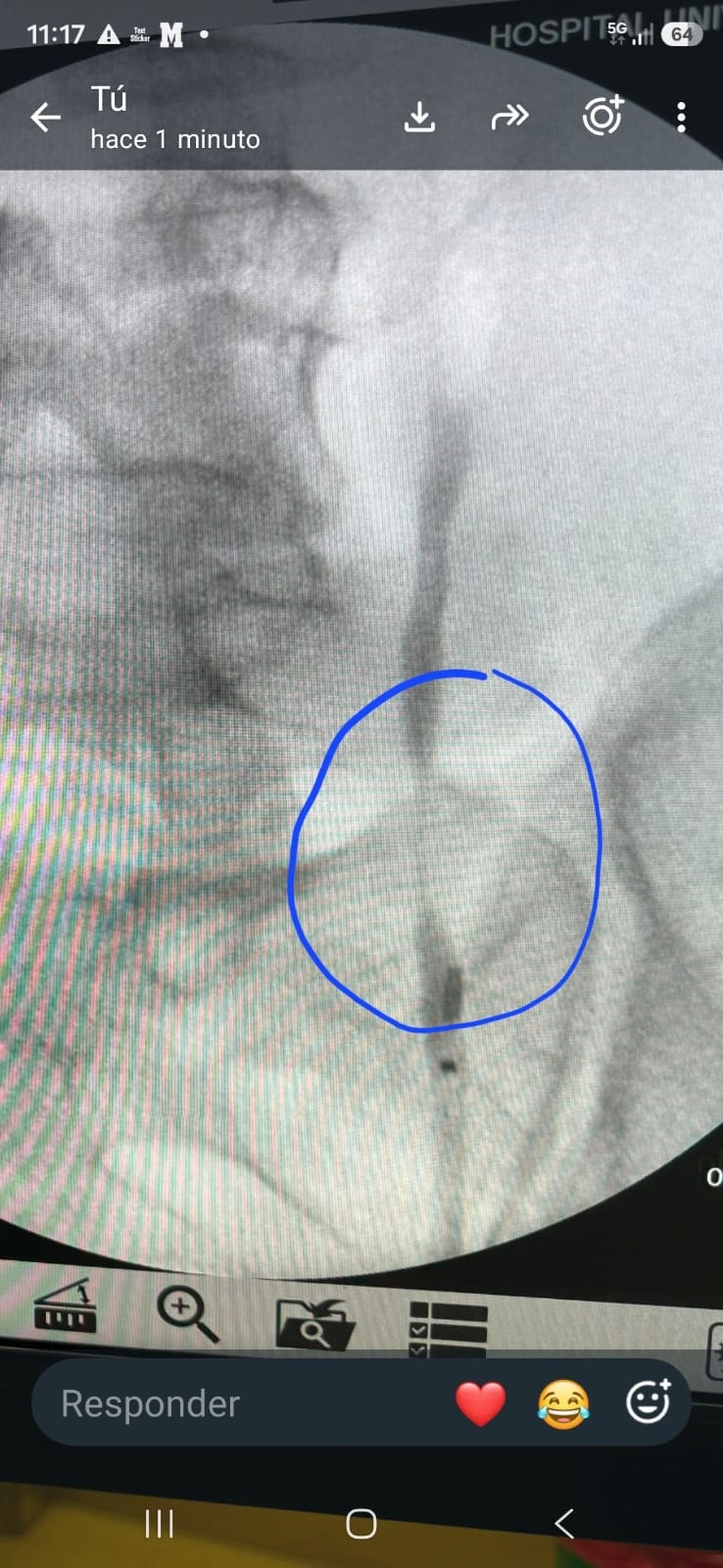 El HUCE implanta con éxito el primer stent de tecnología avanzada Allium en Ceuta
