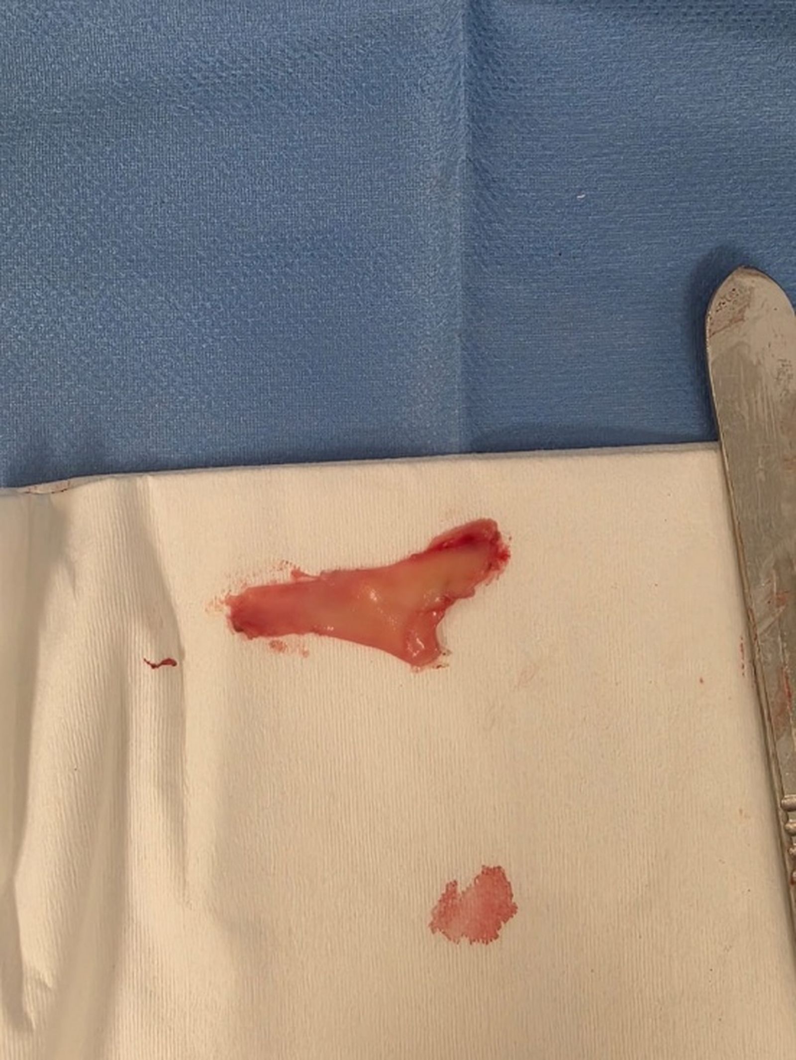 Injerto de mucosa oral que fue suturado al pene. / FOTO CEDIDA