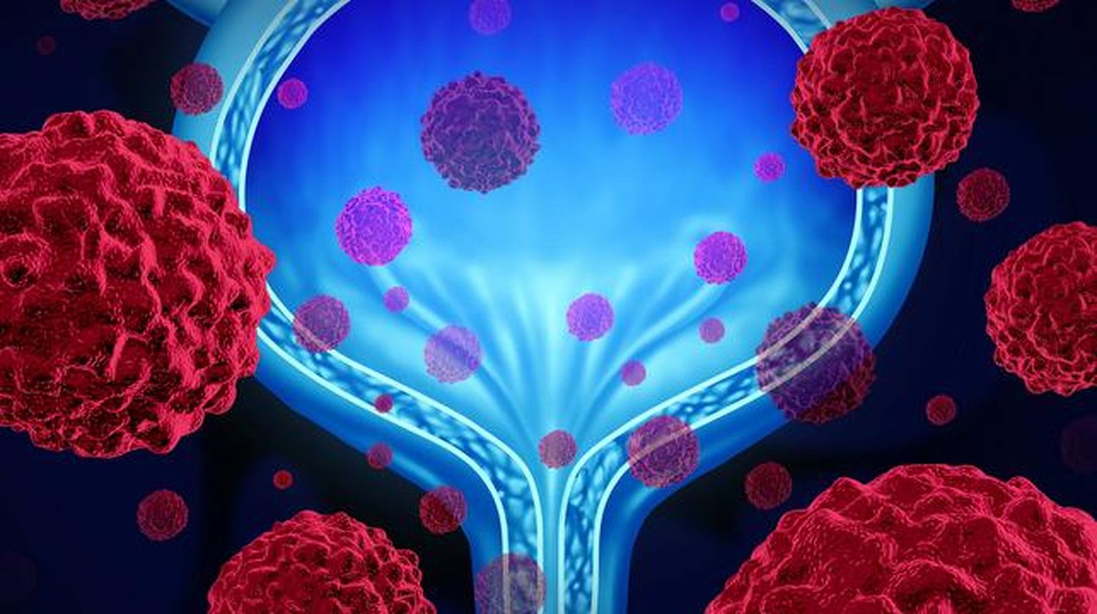 El análisis de ctDNA en sangre permite anticipar la necesidad de inmunoterapia en pacientes con cáncer de vejiga tras la cirugía.