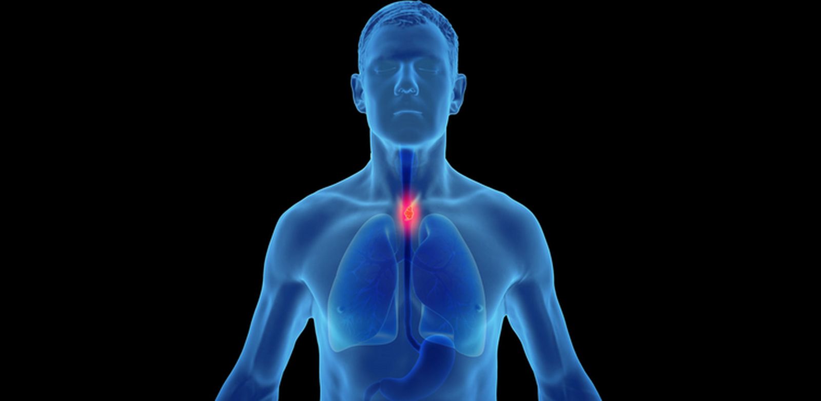 Cáncer de esófago