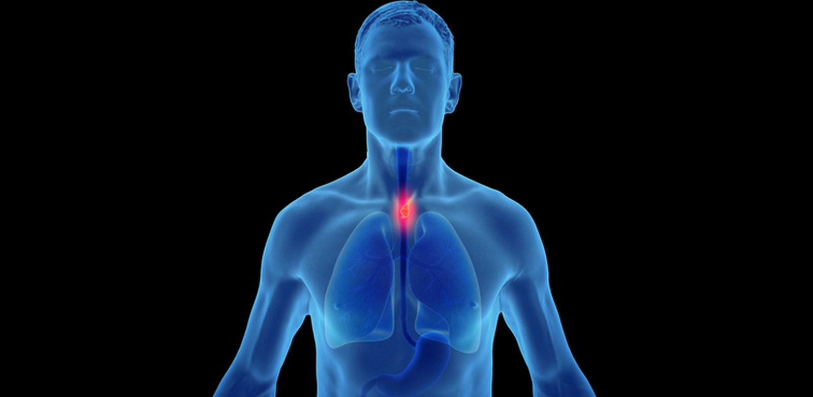 Cáncer de esófago