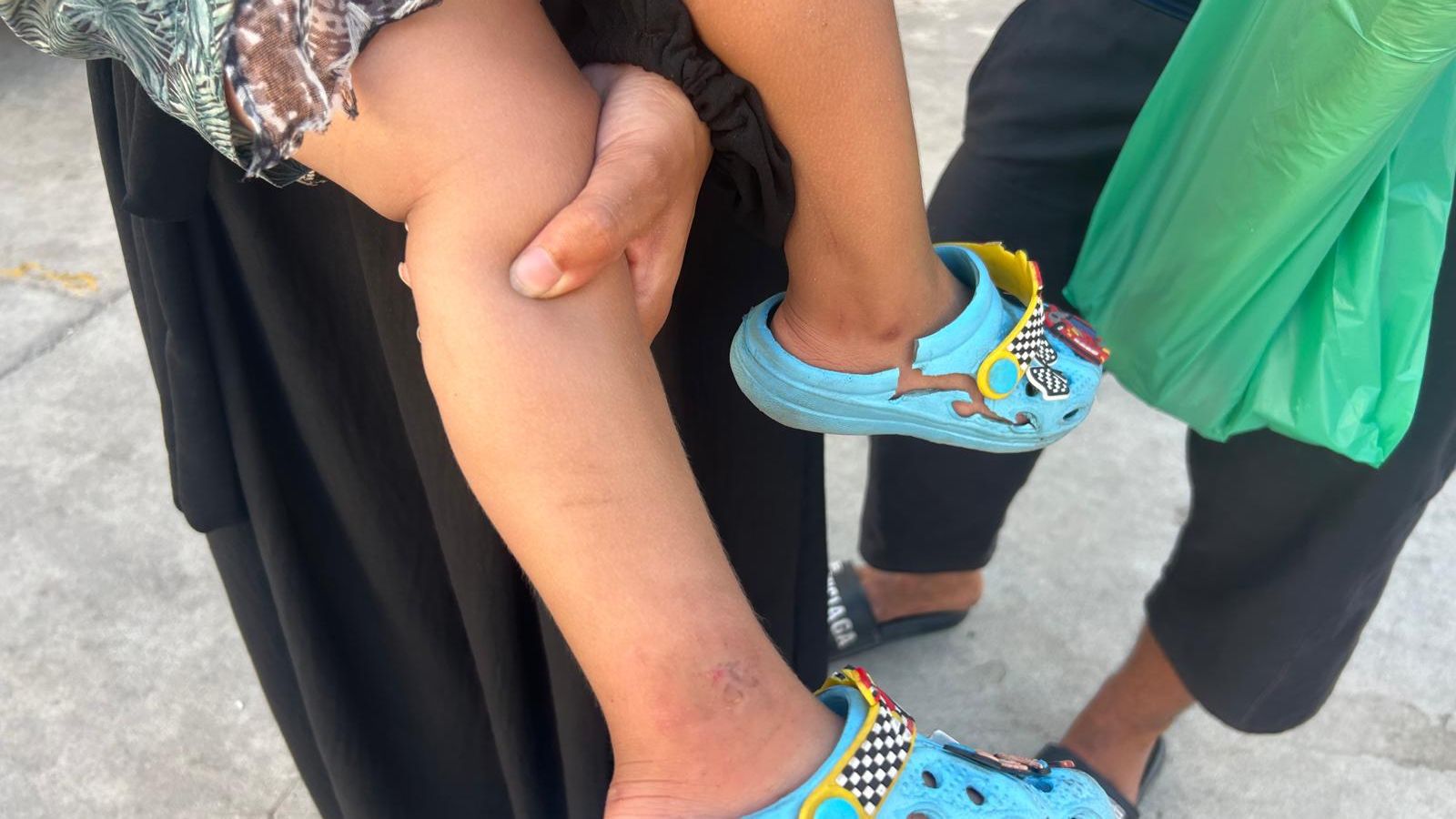 Salma muestra las piernas llenas de rasguños de su hijo