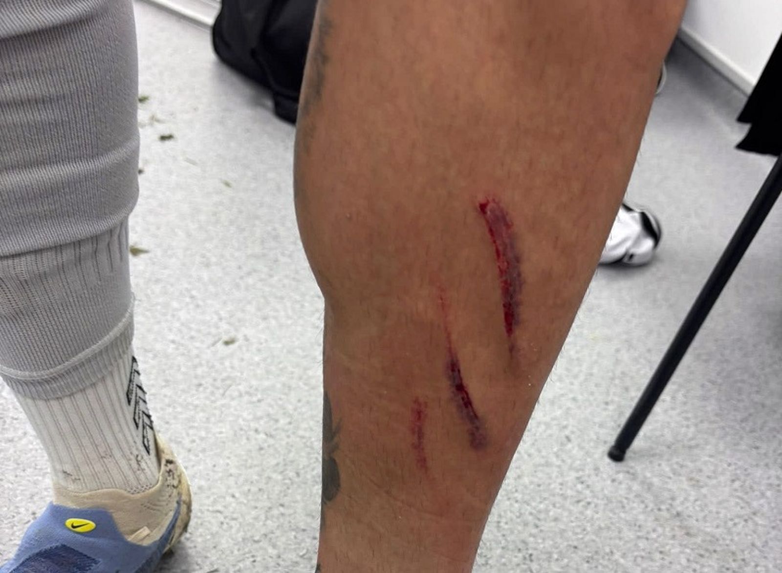 Asi ha quedado la pierna de Cristian