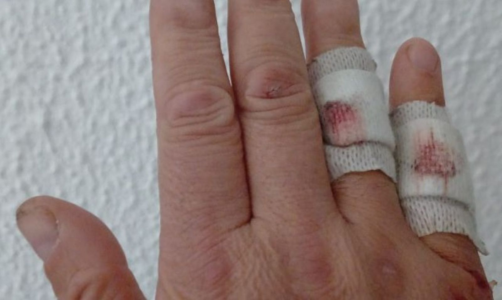 Heridas de uno de los Guardias Civiles