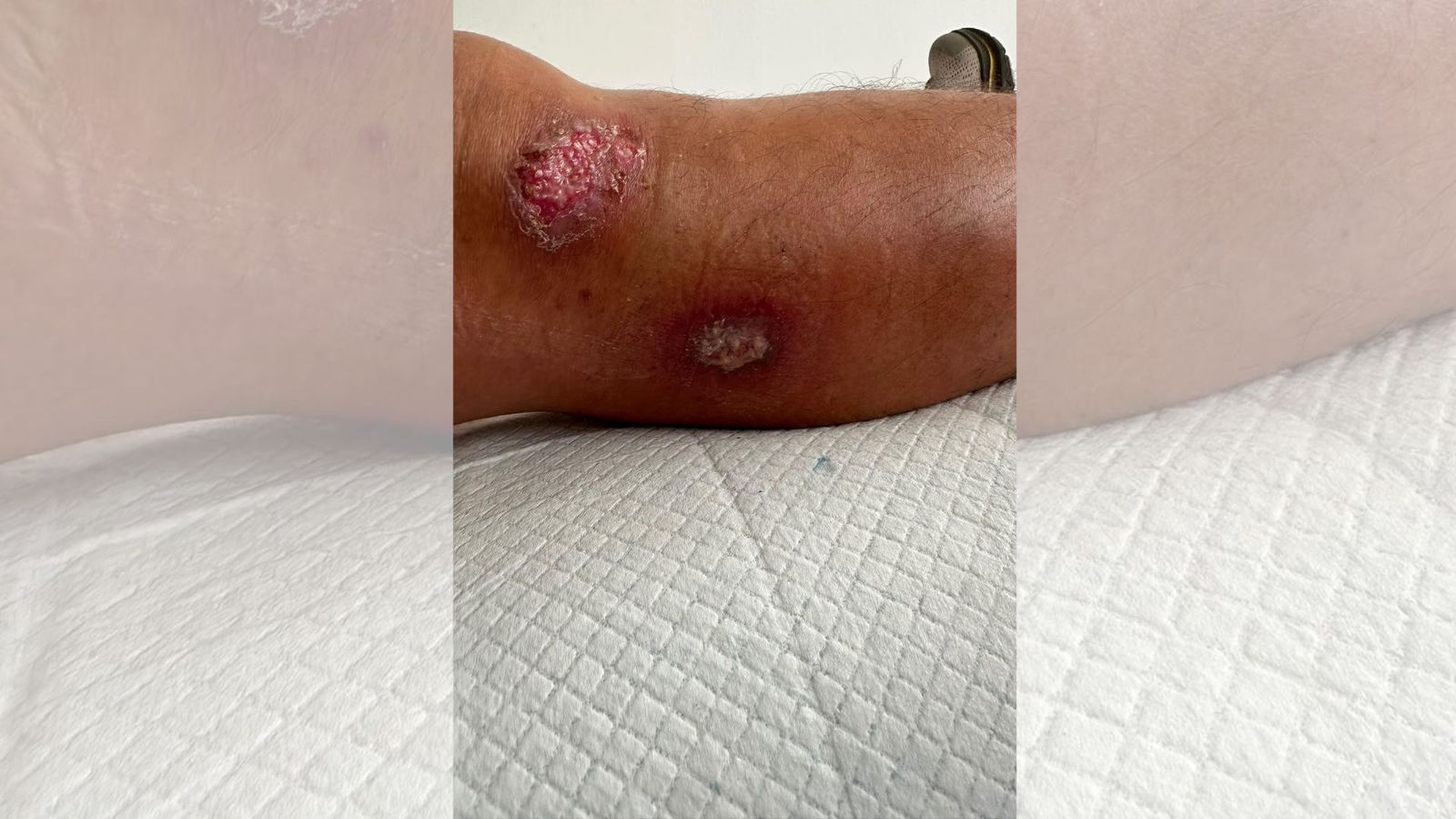 Herida infectada del ceutí diagnosticado de difteria este lunes