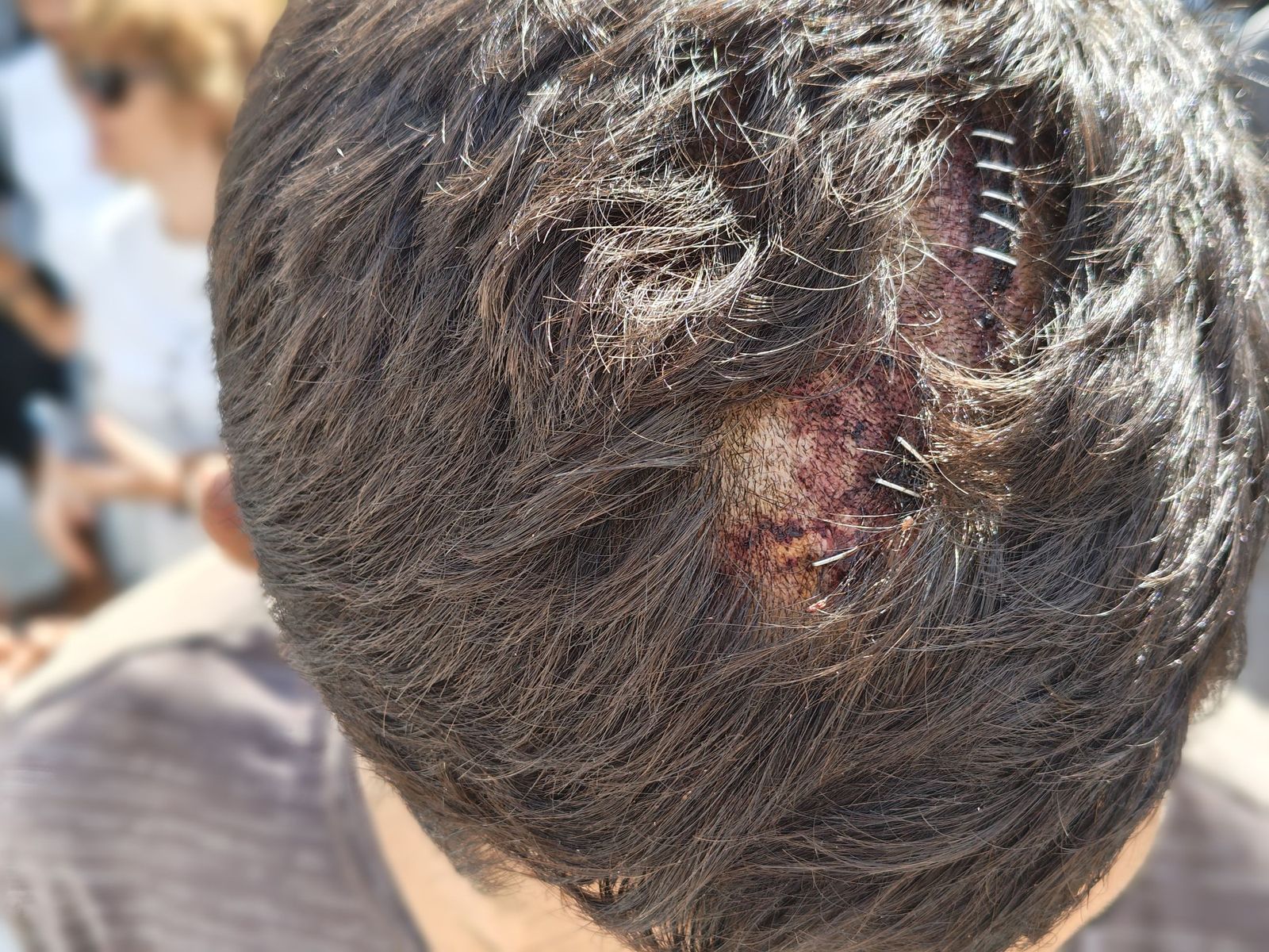 Un menor agredido en la cabeza en el entorno de las naves del Tarajal