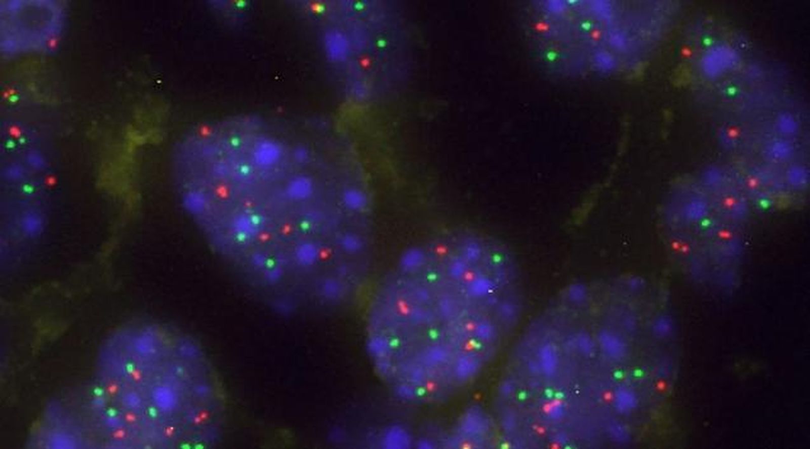 Imagen de células tumorales pulmonares con alteraciones en KRAS analizadas en el estudio del CSIC.