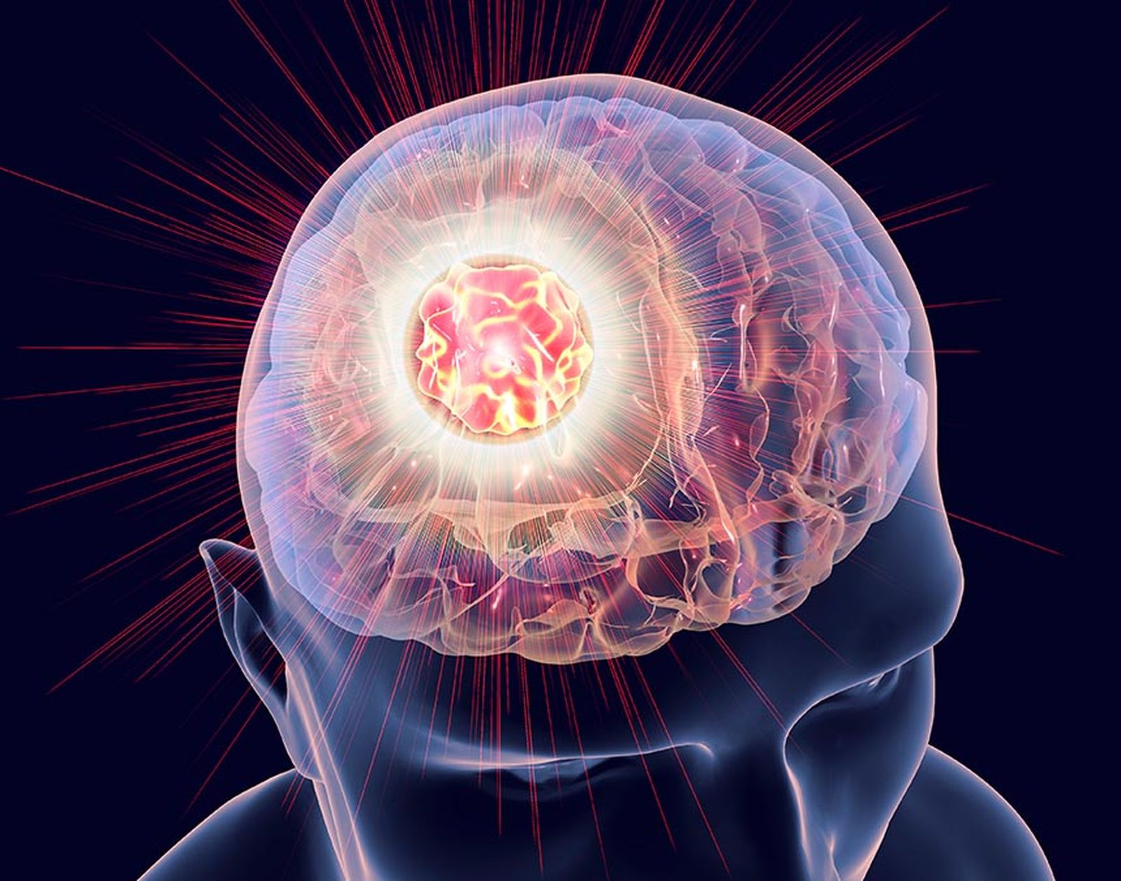 552_tumor-cerebral
