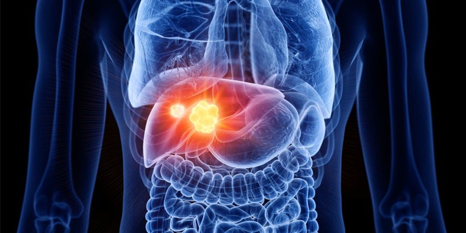 1652_cancer-higado