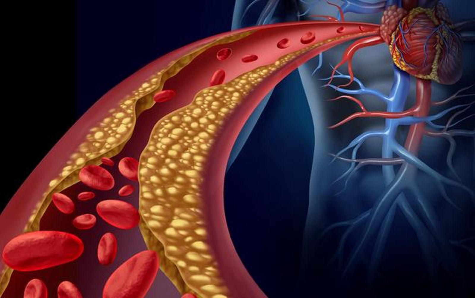 El 73 % de los pacientes españoles con riesgo cardiovascular elevado no alcanza los objetivos de colesterol LDL, según el estudio Santorini España.