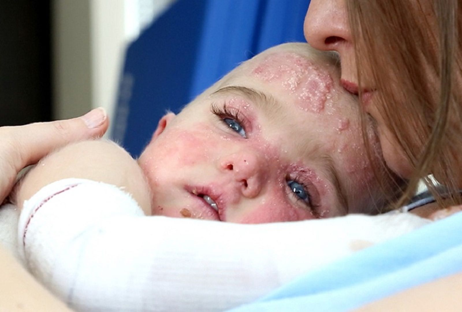 2679_sindrome-de-piel-de-mariposa