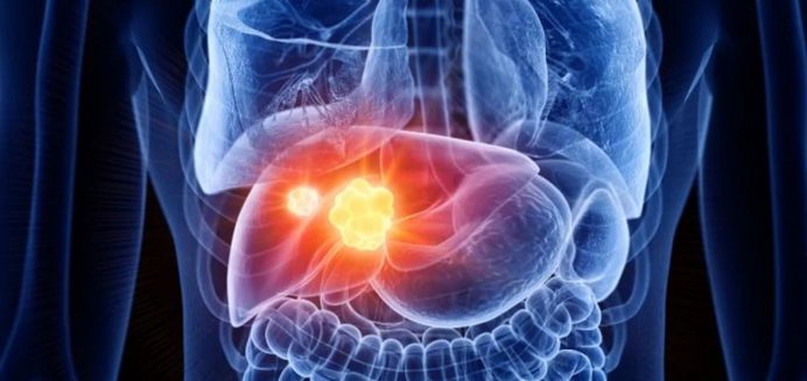 8921_cancer-hepatico