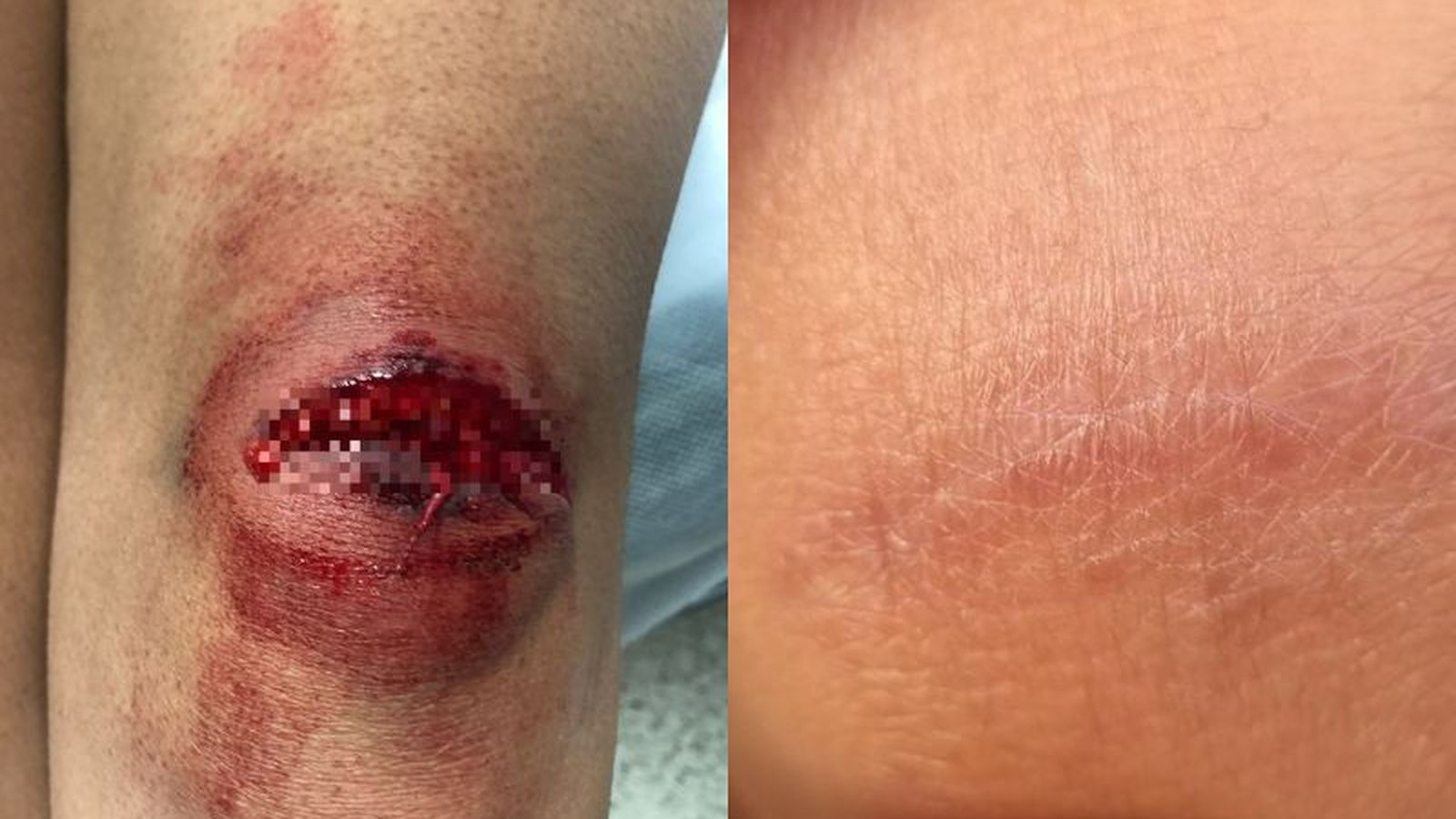 Una herida traumática en rodilla antes y después de ser suturada por Jesús Sánchez con la técnica SETH